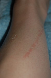 Scratches from bike accident